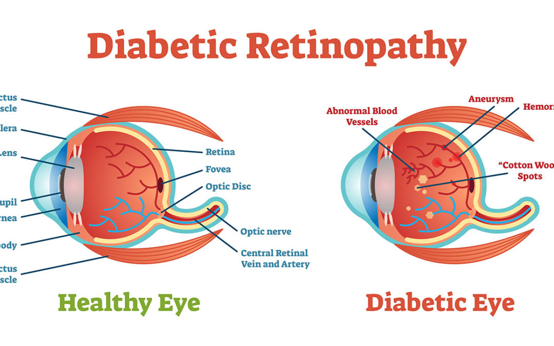 diabetic retinopathy anatomy
