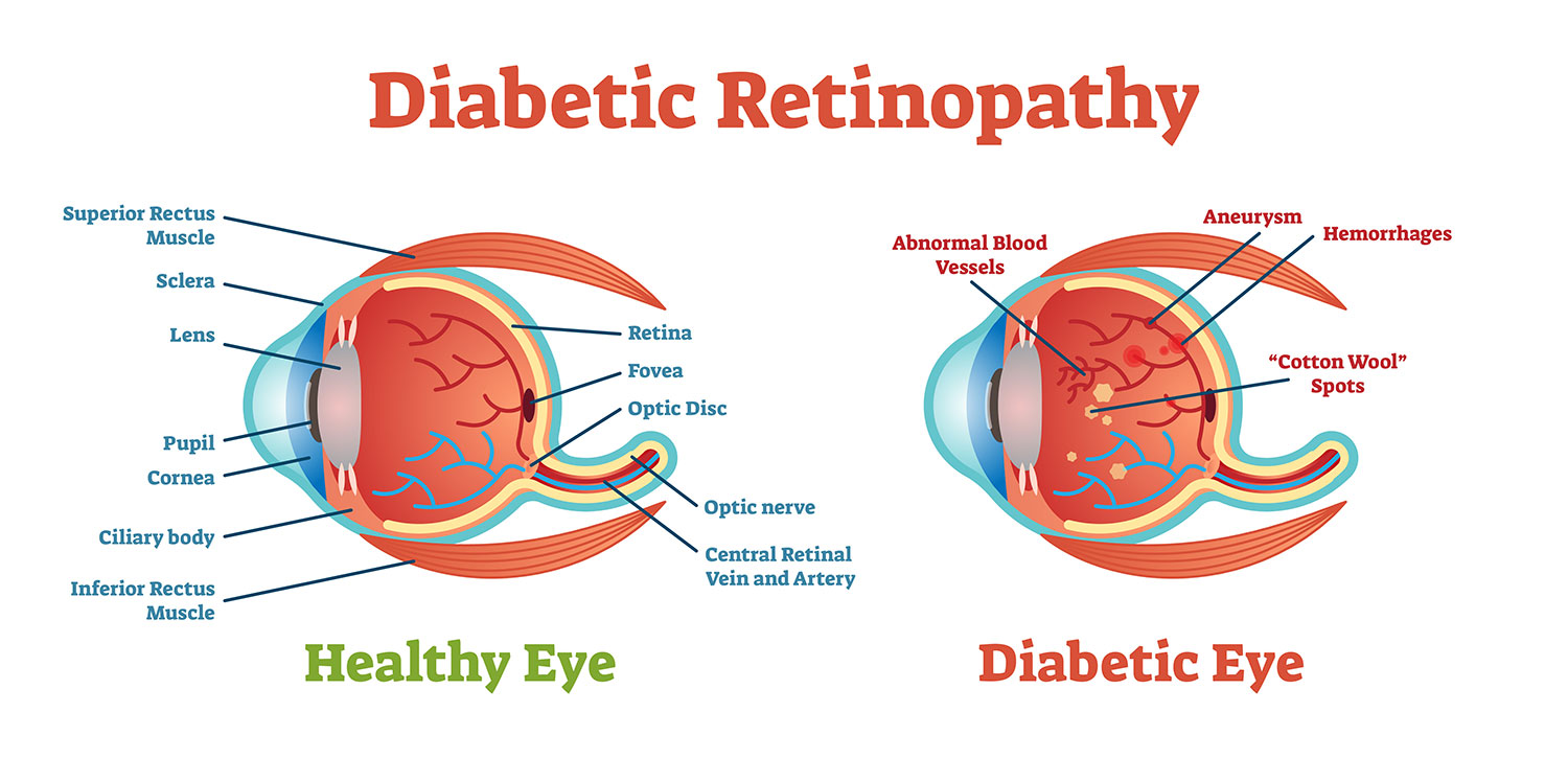 diabetic retinopathy anatomy