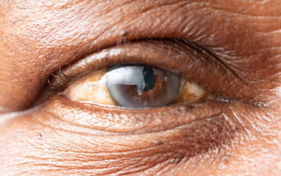 What are Cataracts?