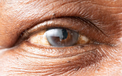 Cataract