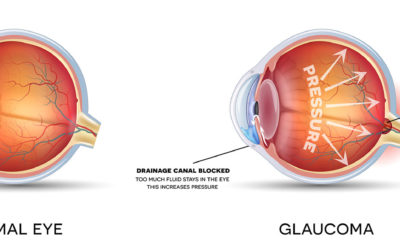 What is Glaucoma?