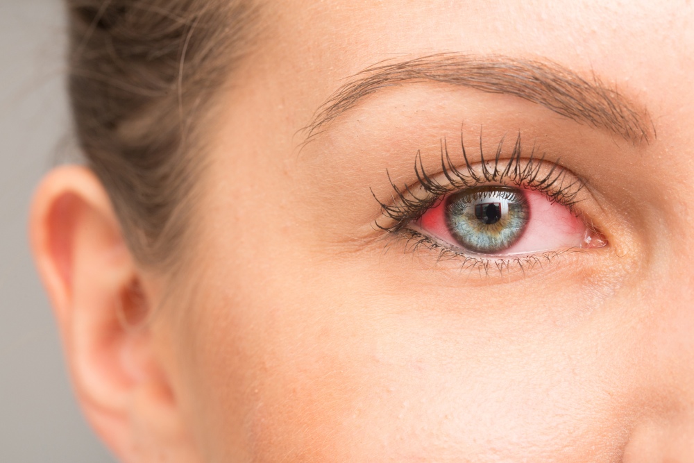 What causes red eyes?