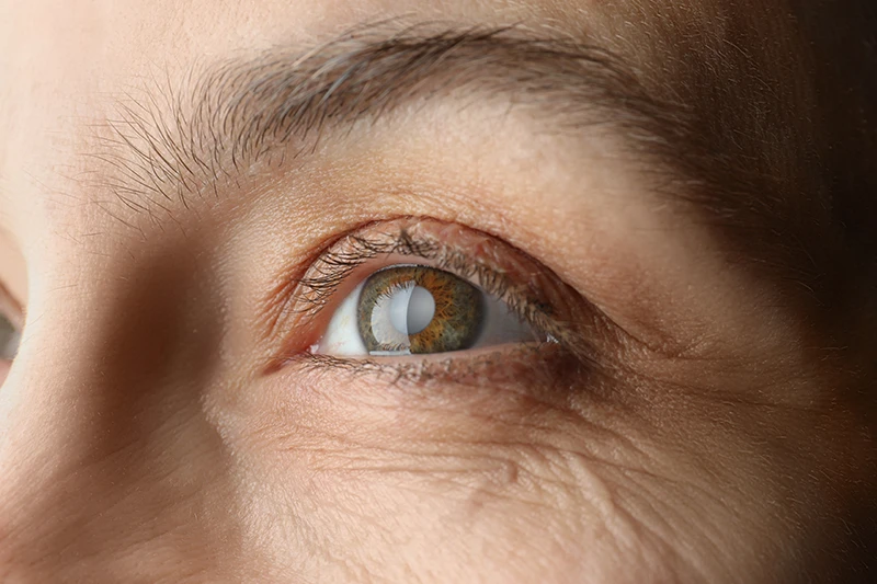 an older woman with a cataract in her eye