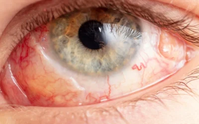 What Is a Retinal Detachment & What Are the Warning Signs?
