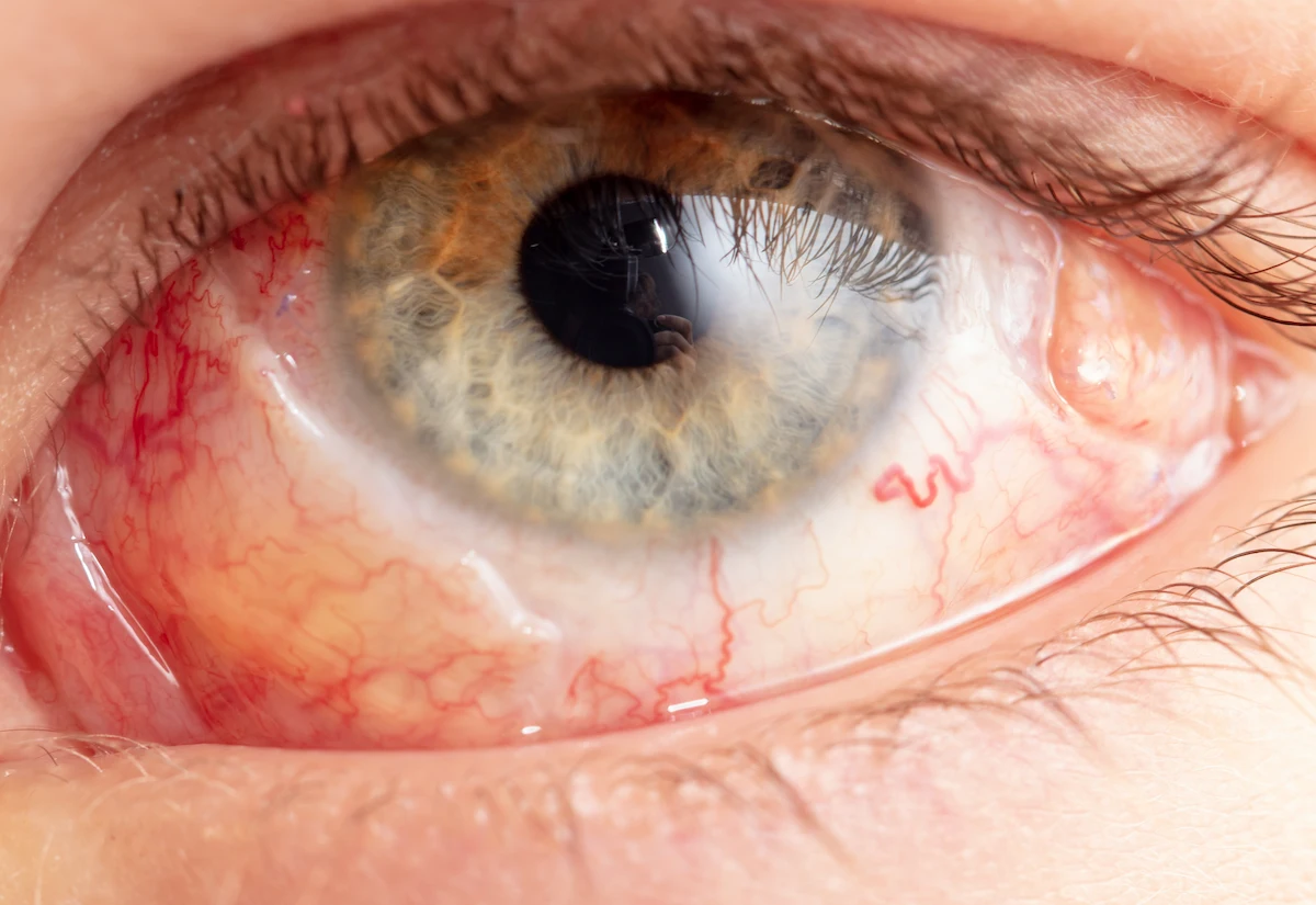 retinal_detachment close-up of eye of patient suffering from retinal detachment